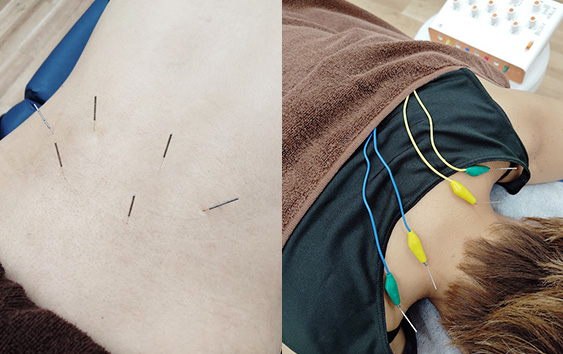 鍼(はり)+整体コース